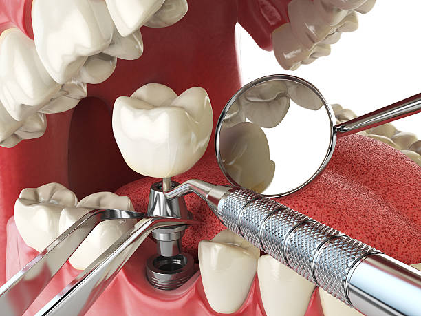 Best Emergency Wisdom Tooth Extraction in Columbus Grove, OH